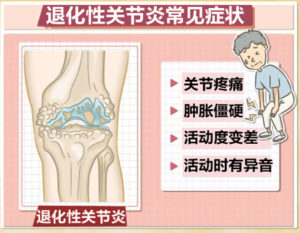 Osteoarthritis (1a)