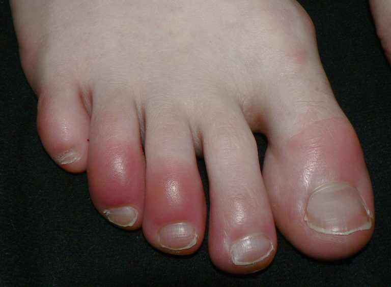 脚趾变色非冠病引发，其实是冻疮
