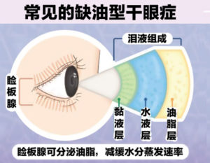 Dry Eye Syndrome (1a)