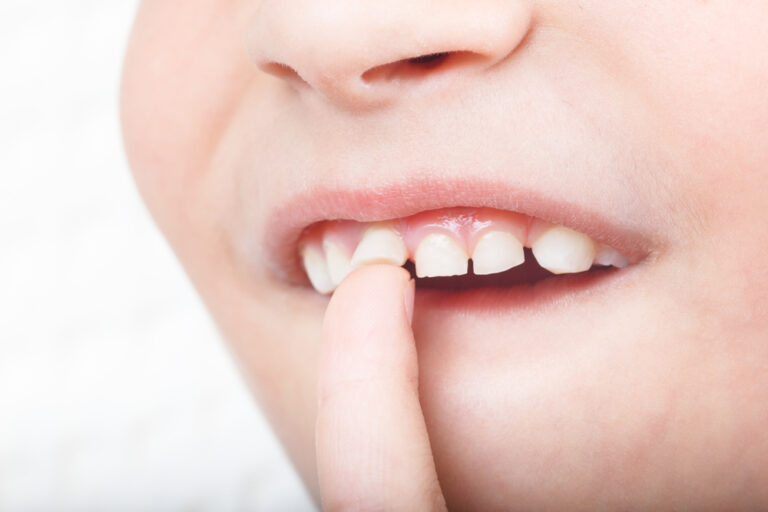10岁童门牙断一半 4方法可修复