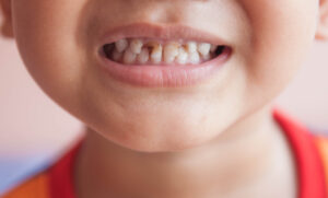 侯锦泉-定期牙检 减糖食 勤刷牙 涂封闭剂 有效防治乳牙蛀牙